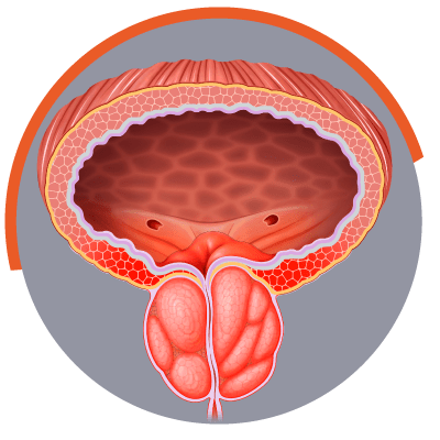 imagem ilustrativa do tratamento Hiperplasia Da Próstata